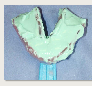 <p>mix the alginate and load the tray</p><ul><li><p>aim for medium consistency - not too sloppy (start new mix if unsuitable)</p></li><li><p>fill tray up to the top</p></li><li><p>avoid overfilling - especially the upper tray posteriorly where overflow likely</p></li></ul><p></p>