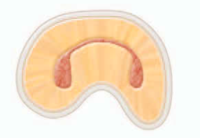 <p><span><strong><span>characterized by two canals with a definite connection between them (complete isthmus).</span></strong></span></p>
