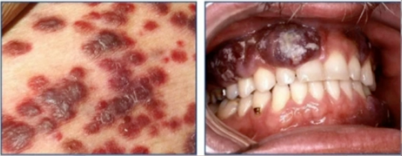 <p>what disease are these lesion associated with?</p>
