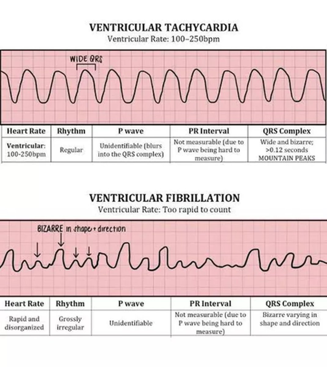 <p>very rapid heartbeat beginning in ventricles</p><p>- sinus tach: fast rate, normal rhythm</p><p>- premature ventricular complex (PVC): </p><p>> 2 = couplet, 3 = triplet, 4 = V-tach</p><p>> common, only treated if bothersome</p><p>- V-tach: may be sustained (>30 beats/run) or non-sustained</p><p>> if pulseless, treat like V-fib</p><p>- V-fib: no squeeze (pulseless)</p><p>> cannot produce forward flow of blood</p><p>- Torsades de Pointes: result of prolonged QT interval, usually drug induced</p>