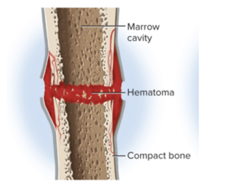 <p>The hematoma is converted to granulation tissue by the invasion of cells and blood capillaries</p><ul><li><p>periosteum helps keep the blood clot in place</p></li></ul><p></p>