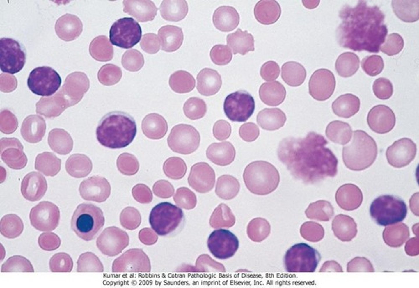 <p>B-cell neoplasm with small, mature lymphocytes.</p>