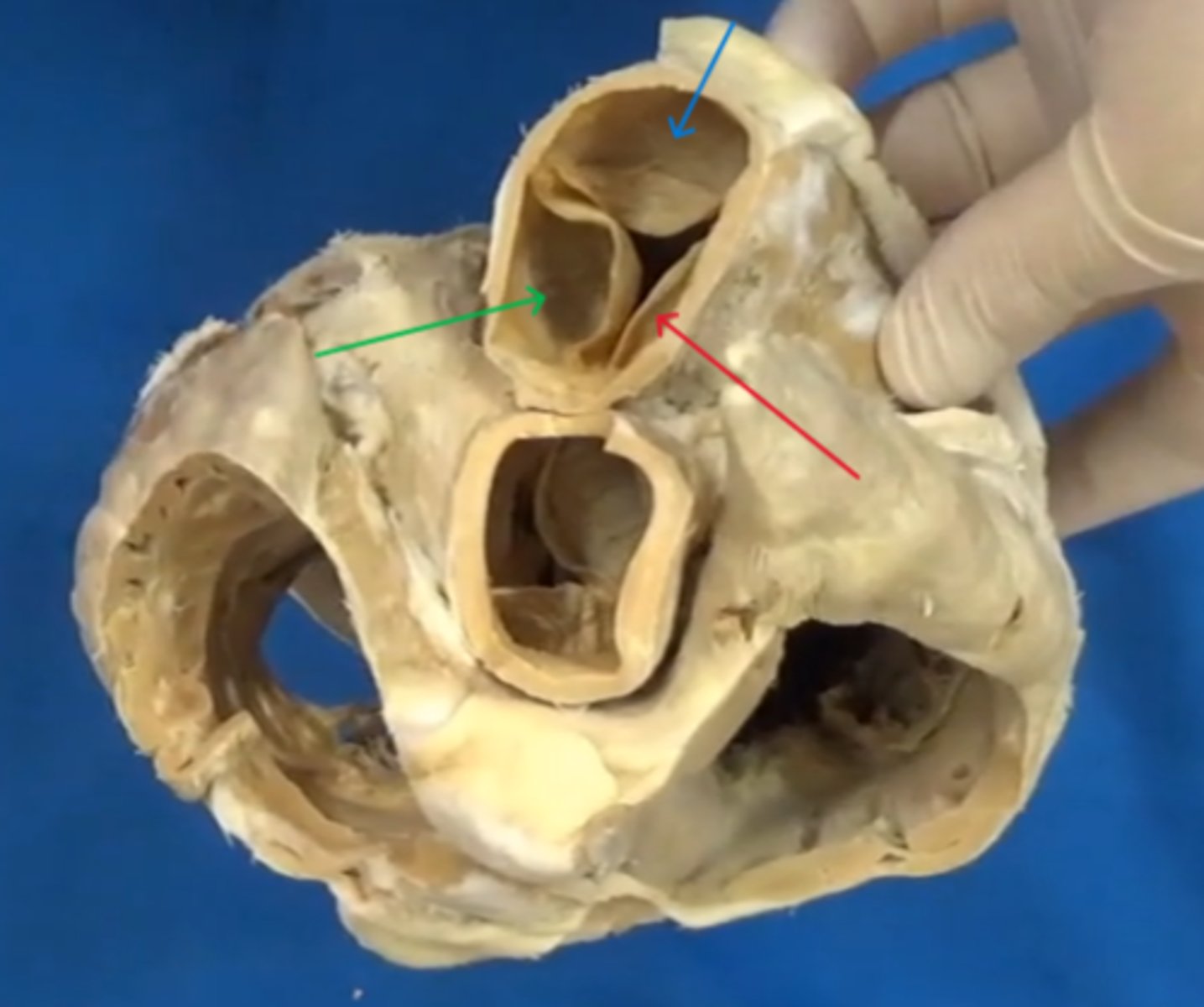 <p>Name the Red Arrow (Part of Right Ventricle)</p>