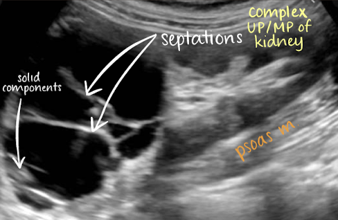 <p><mark data-color="yellow" style="background-color: yellow; color: inherit;">complex cyst</mark></p><ul><li><p>has septations and solid components</p></li></ul><p></p>