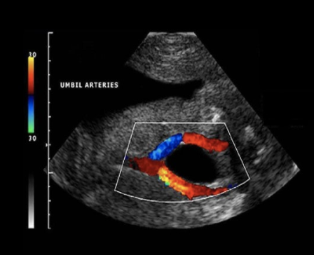 <p>while performing an anatomy scan on a 22w fetus, you are <strong>unable</strong> to obtain a cross-sectional image of the umbilical cord to <strong>show</strong> the <strong>number</strong> of <strong><u>umbilical arteries</u></strong>. </p><p>.</p><p>what is an alternative method to evaluate the arterial anatomy of the cord</p><p>.</p><p>a) obtain a cross-section view of the umbilical cord insertion at the placenta + apply color doppler</p><p>b) obtain a transverse view of the fetal abd at the level of the kidneys + apply color doppler</p><p>c) obtain a transverse view of the fetal pelvis at the level of the bladder + apply color doppler</p><p>d) obtain a midline sagittal view of the fetus that includes the fetal bladder + apply color doppler</p>