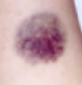 <p>Vascular Skin Lesion</p><ul><li><p>Due to <strong>trauma</strong></p></li><li><p><strong>Raised ecchymosis</strong></p></li><li><p>Aka Bun-og; <strong>blue, purple, or black</strong> in color</p></li></ul><p></p>