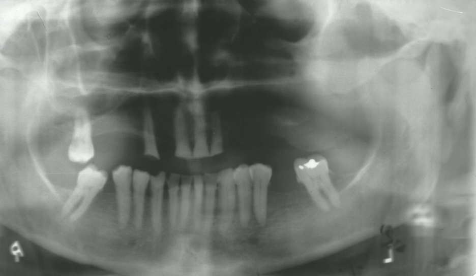 <p>left facial swelling, numbness V2 for 3 months, intraoral soft tissue swelling, most likely diagnosis?</p>