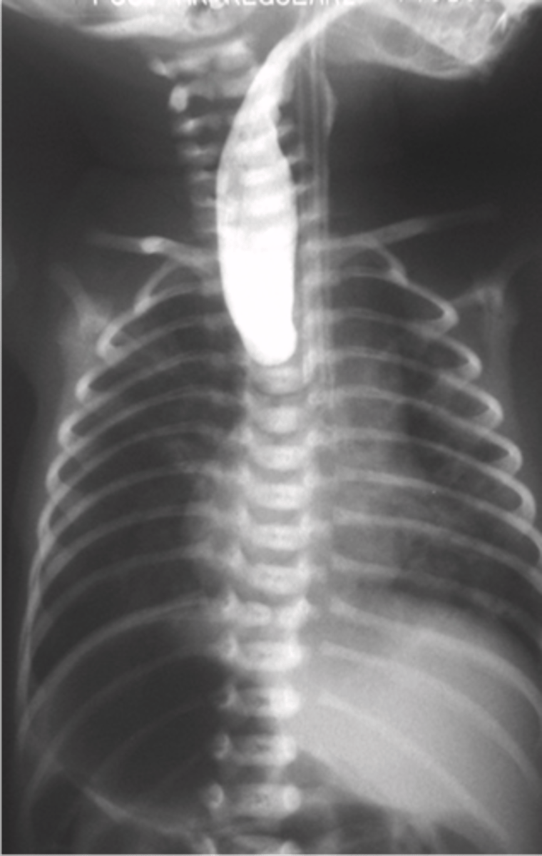 <p>What is Esophageal Atresia</p>