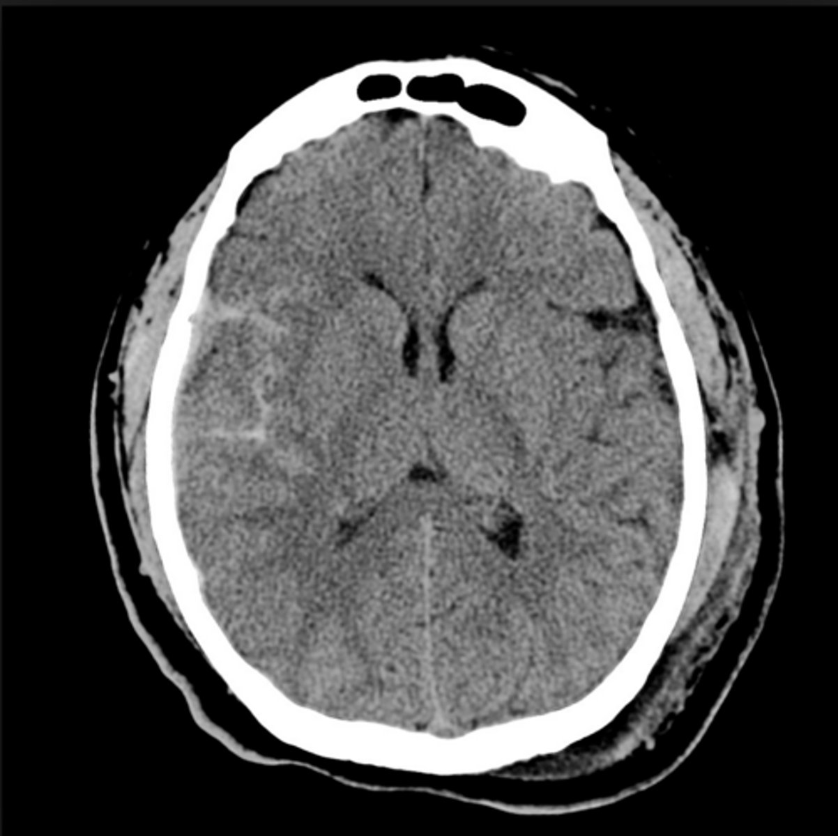 <p>Bleeding in the subarachnoid space between the pia &amp; arachnoid mater; sudden severe headache ("thunderclap headache," "worst headache of my life," etc.)</p>