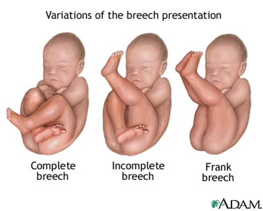 <p>What is breech presentation?</p>