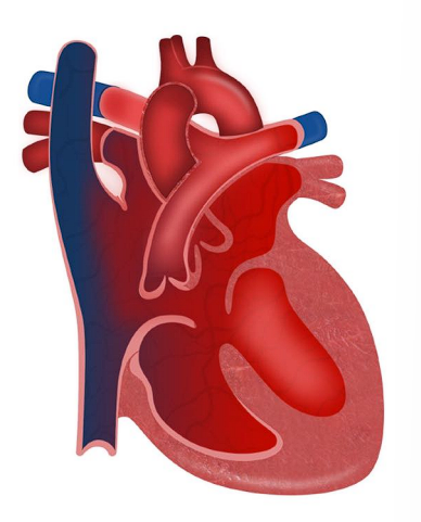 __**● Defect:**__  

○ Opening between the atria AND the ventricles 

○ ASD + VSD + Single AV Valve 

__**● Shunt:**__  

○ Left to right. Acyanotic  

__**● History:**__  

○ Heart failure s/s and failure to thrive  

__**● Assessment findings:**__  

○ Murmur  

○ \*High risk for heart failure  

__**● Treatment**__  

○ CHF management: Digoxin, diuretics, ACE inhibitors,  and β-blockers 

○ Nutrition 

○ Complete surgical repair at 3-6 months 

■ Bacterial endocarditis prophylaxis