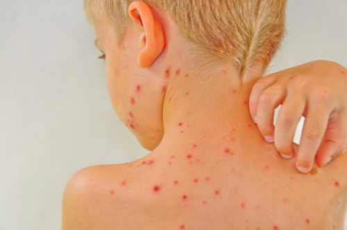 Chickenpox or Varicella