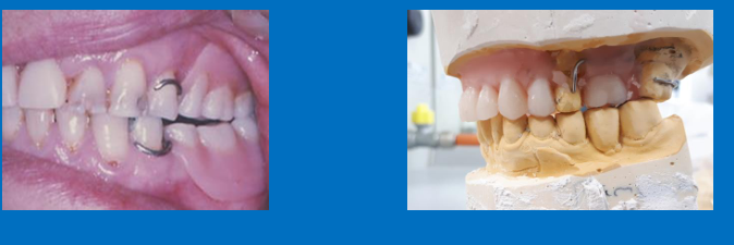 <p>What occlusion is used here and why?</p>