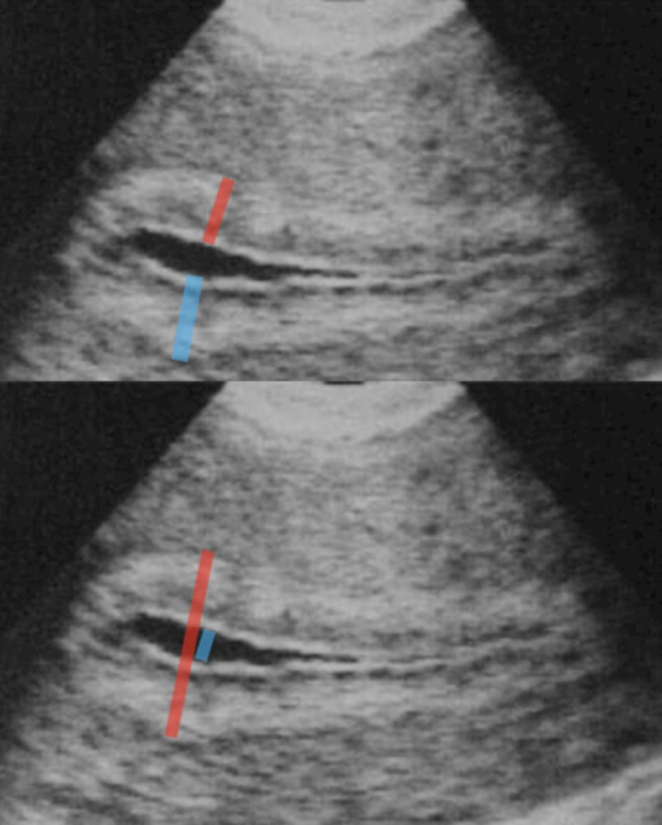 <p>measure endo as 2 separate measurements</p>