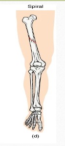 <p>Bone segments are pulled apart as a result of a twisting motion </p>