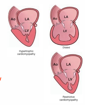 <ul><li><p>Dilated cardiomyopathy</p></li><li><p>Hypertrophic cardiomyopathy</p><ul><li><p>Different to hypertrophies because they are secondary to other disease (these happen spontaneously)</p></li></ul></li><li><p>Restrictive cardiomyopathy</p></li></ul><p></p><p></p>
