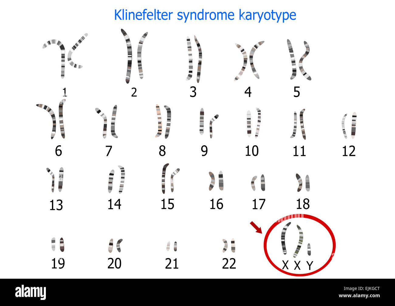<p>Klinefelters Syndrome mutation:</p>