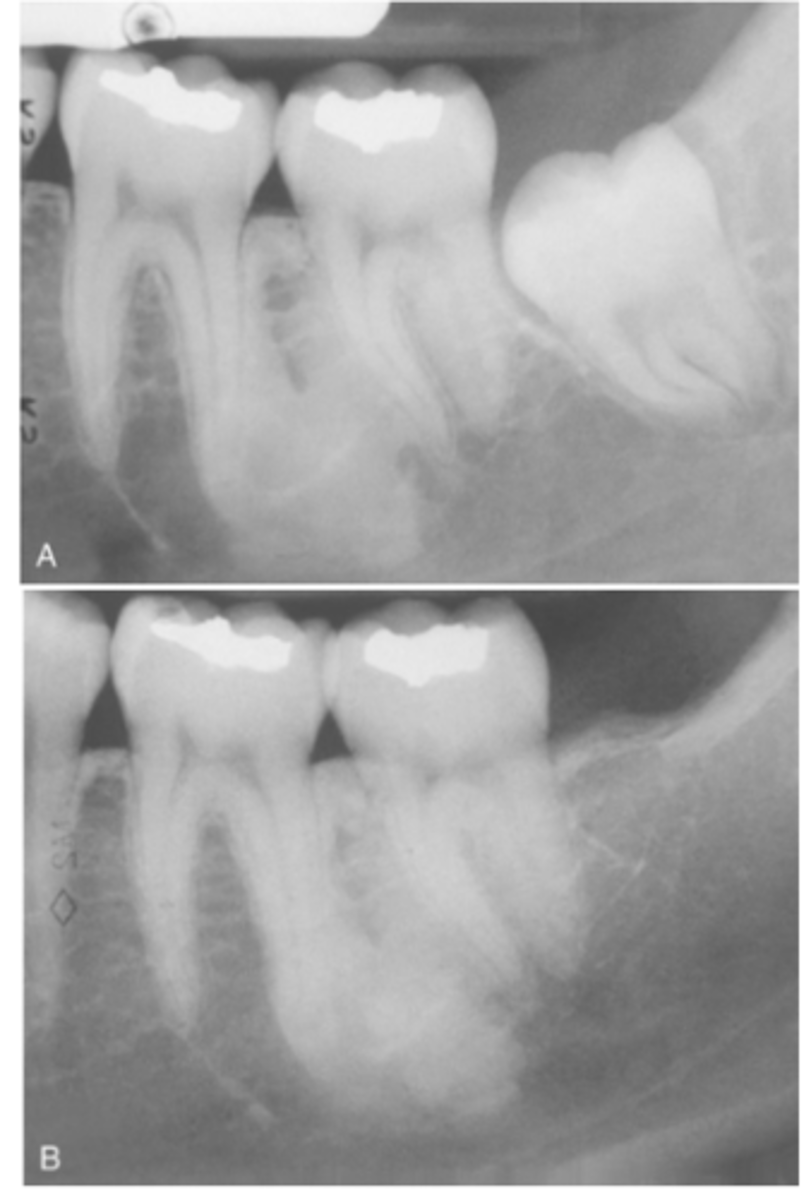 <p>What teeth (in order) in the mandible are most affected in Idiopathic Osteosclerosis </p>