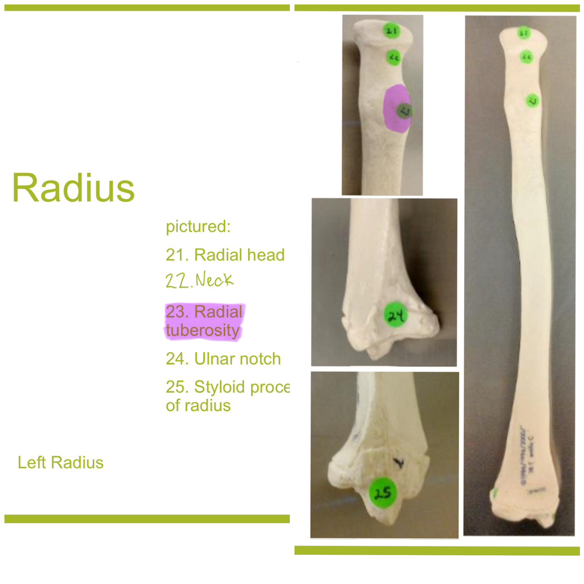<p>radial tuberosity of radius</p>