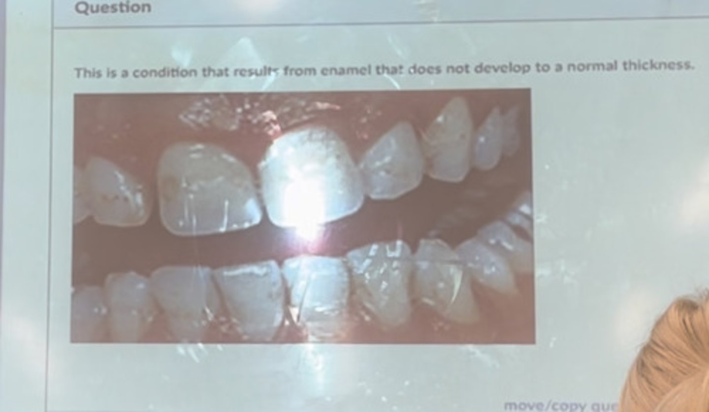 <p>This is a condition that results from enamel that does not develop to a normal thickness</p>