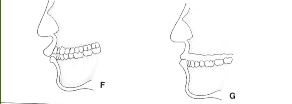 <p>Radical contouring of alveolar ridge due to horizontal discrepancy between jaws with protrusion or overjet </p>