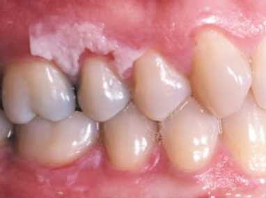 <p>resulting from placing aspirin next to toothache </p>