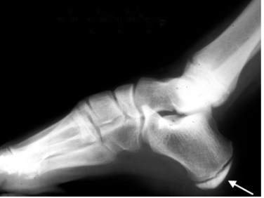 <p><span>A Note about Sever’s Disease</span></p><ul><li><p>Young athletes (11-13)</p></li><li><p>Associated with growth spurts</p></li><li><p>Be careful with your language</p></li><li><p>Activity modification</p></li><li><p>Stretch the gastroc/soleus</p></li><li><p>inflammation of calcaenus growth plate </p></li><li><p>manage by decreasing pull of gastroc </p></li><li><p>increase muscle length there with soft tissues techniques</p></li></ul><p></p>