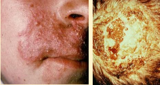<p>What should you avoid doing to the bubbly pustules of trichophyton verrucosum?</p>