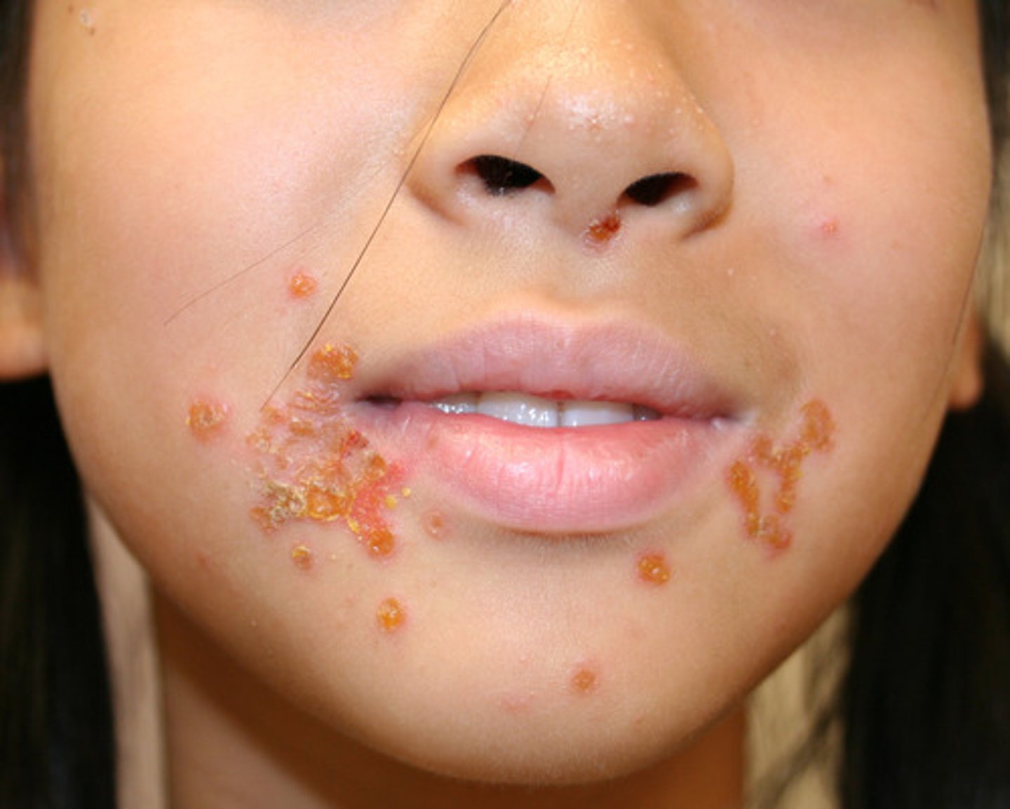 <p>Erythematous papules → vesicles → rupture → honey-colored crusts, typically on face (around nose/mouth)</p>