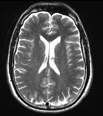 <p>T2 is good for detecting pathologies such as cysts </p><ul><li><p>Water is bright</p></li><li><p>Fat is grey </p></li></ul><p></p><p><u>Applications:</u> </p><p><span>T2 focuses on pathology, making fluids bright, which is ideal for visualizing inflammation, edema, and certain lesions</span></p><p></p>