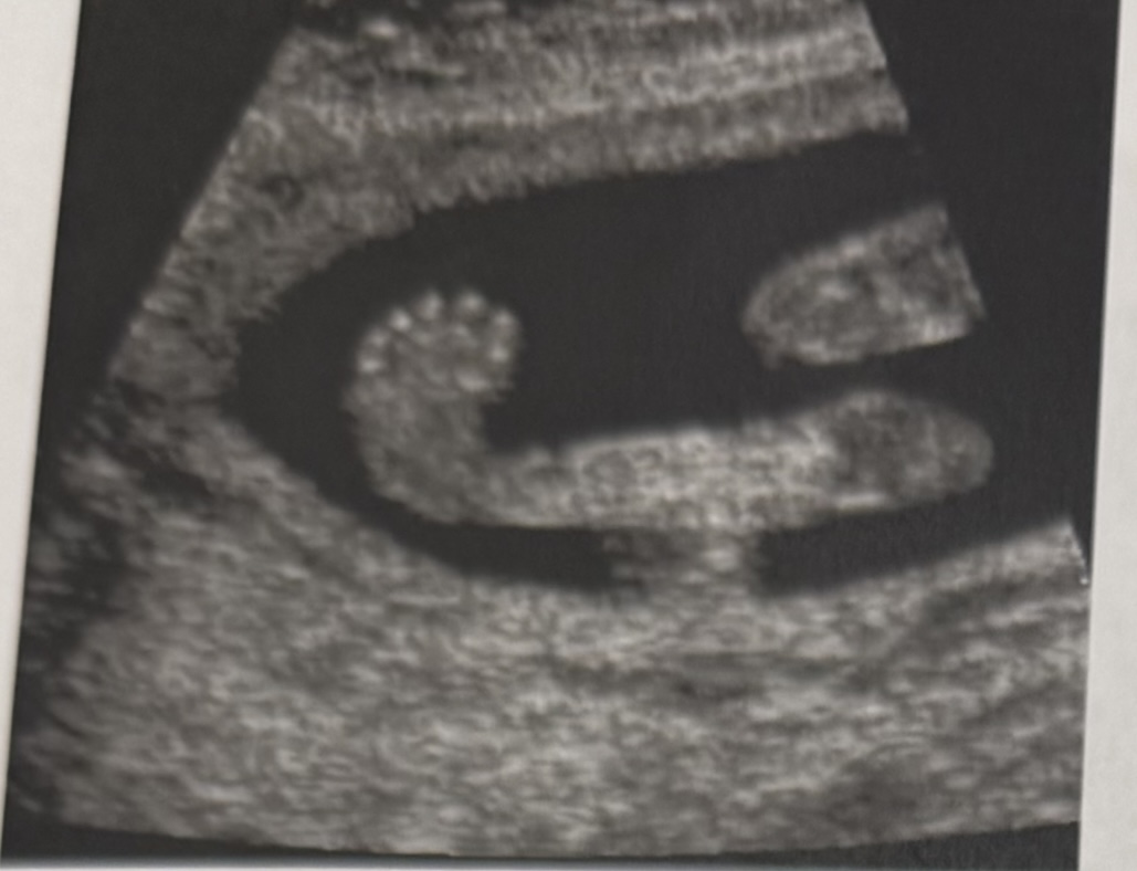 <p>What is the image showing?</p><p>a. Tallies equino varus</p><p>b. Rocker bottom foot</p><p>c. Normal fetal foot</p>