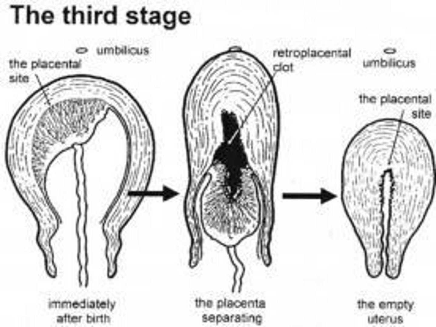 <p>The stage from the birth of the baby until the placenta is expelled.</p>
