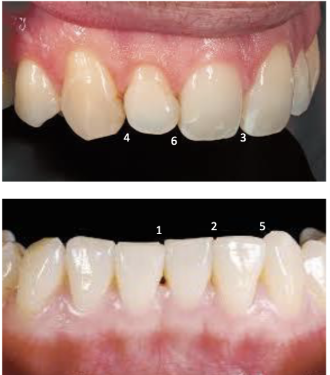 <p>between maxillary central incisors (3)</p>
