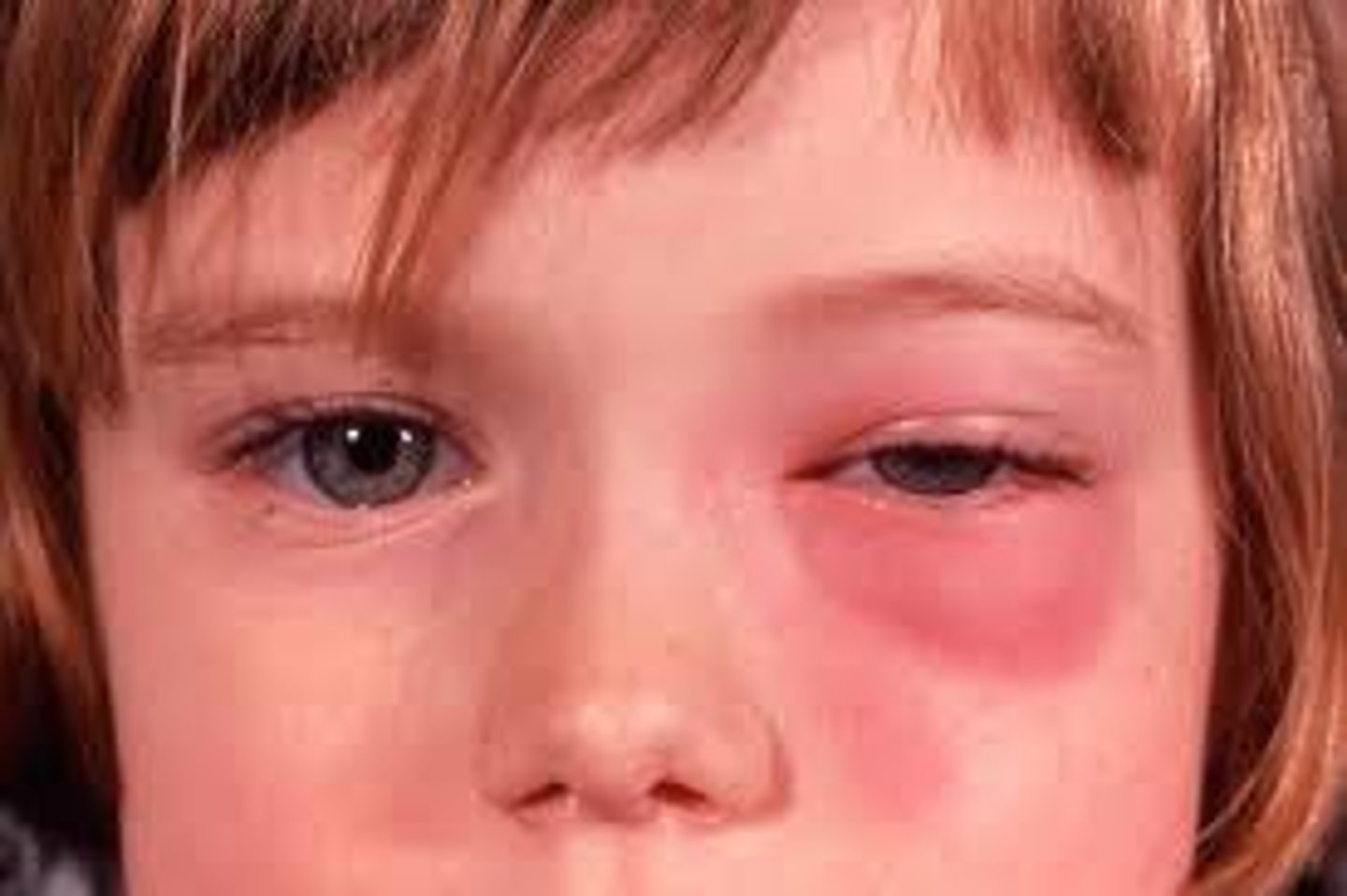 <p>Orbital cellulitis</p>