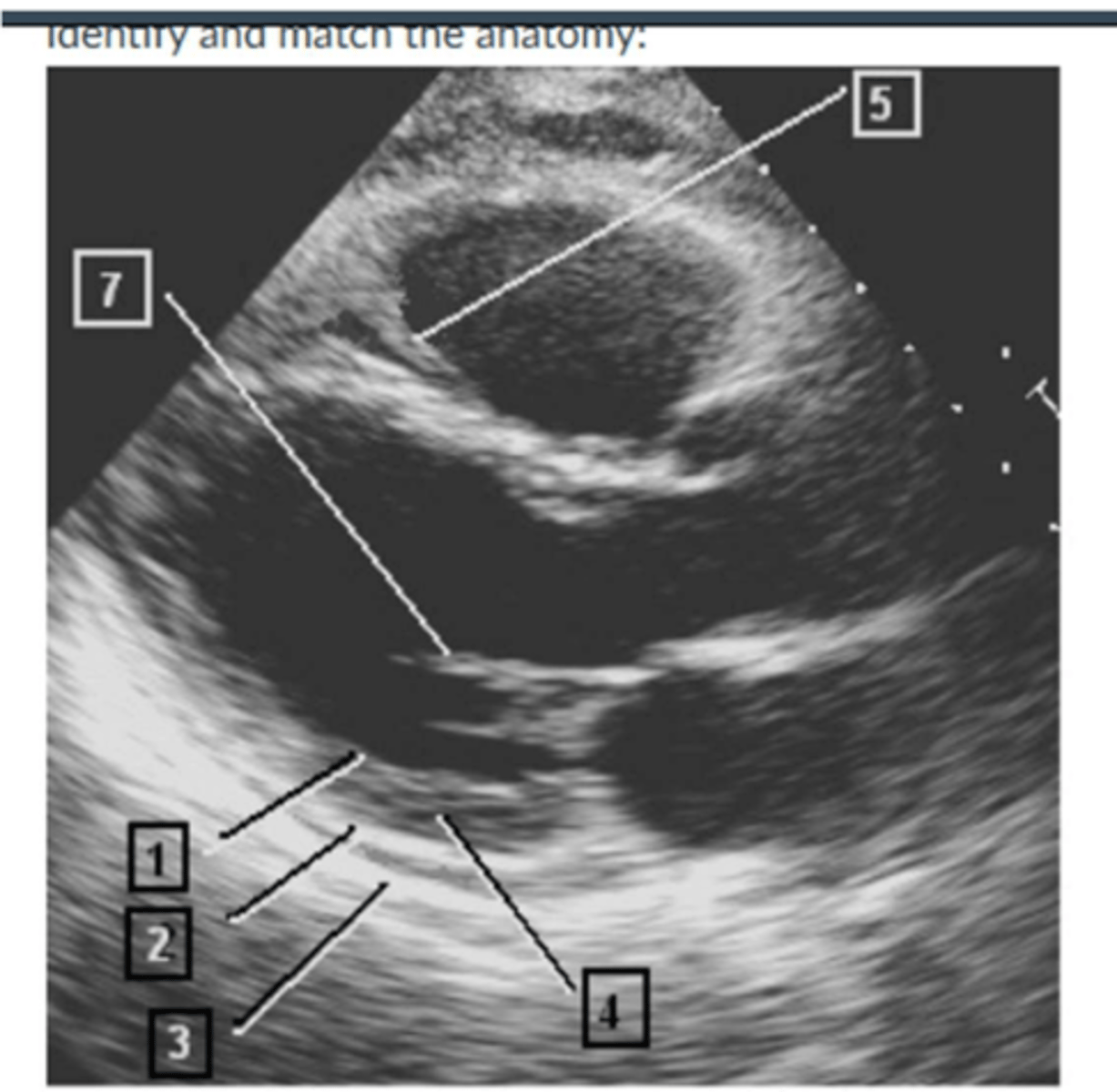 <p>1. endocardium</p><p>2. epicardium</p><p>3. pericardium</p><p>4.</p><p>5. moderator band</p><p>7. chordae tendinea</p>