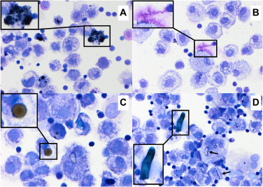 <p>Endoscopy, TBAsp→ Hemosiderin-laden macrophages</p>