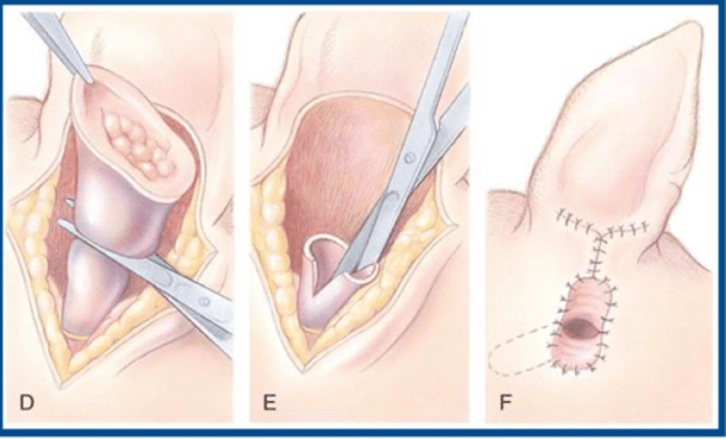 <p>does a vertical or lateral ear canal resection provide better cosmetic appearance</p>
