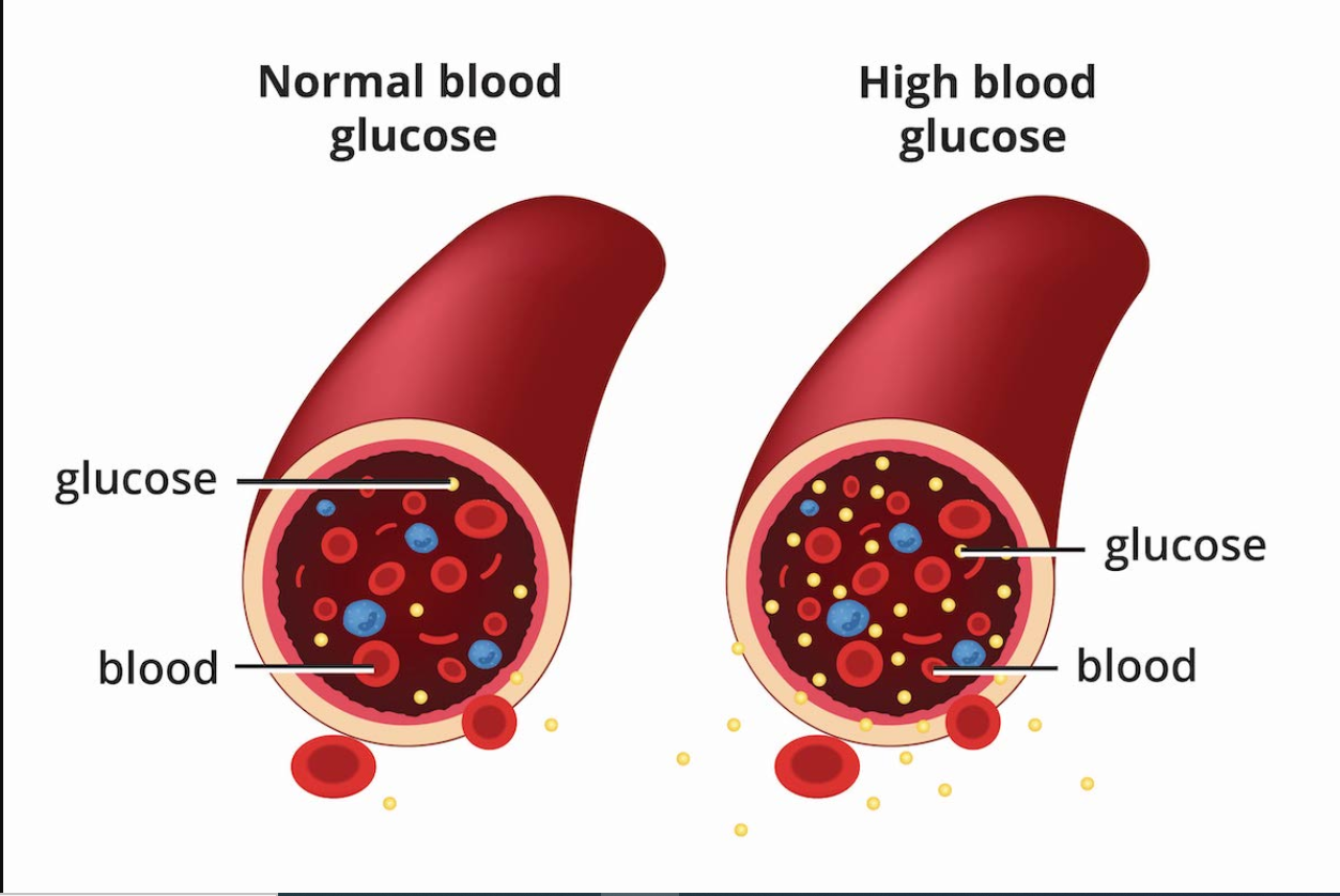 <p>A disorder that causes abnormally high glucose levels in the body due to insulin either being resistance or not produced at all</p>