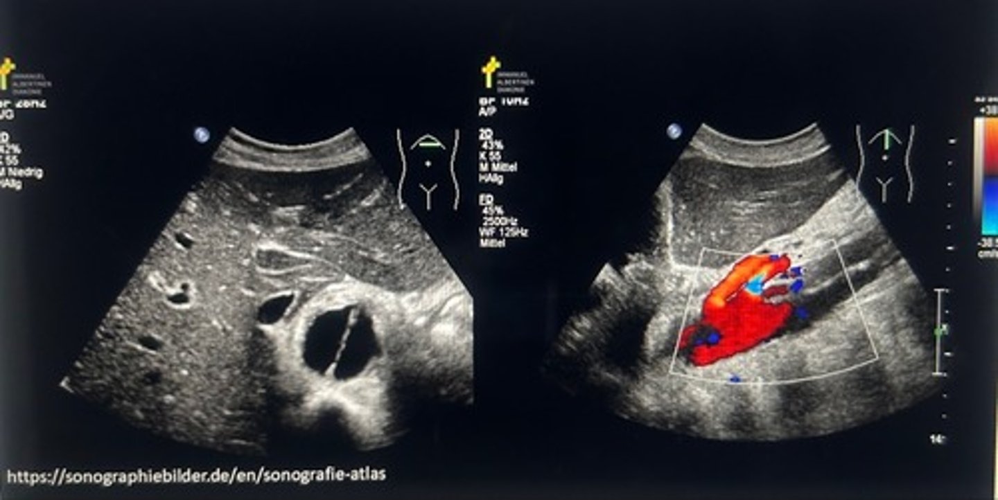 <p>Marian syndrome</p>