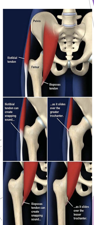 <p>Subluxation vs Snapping Hip</p>