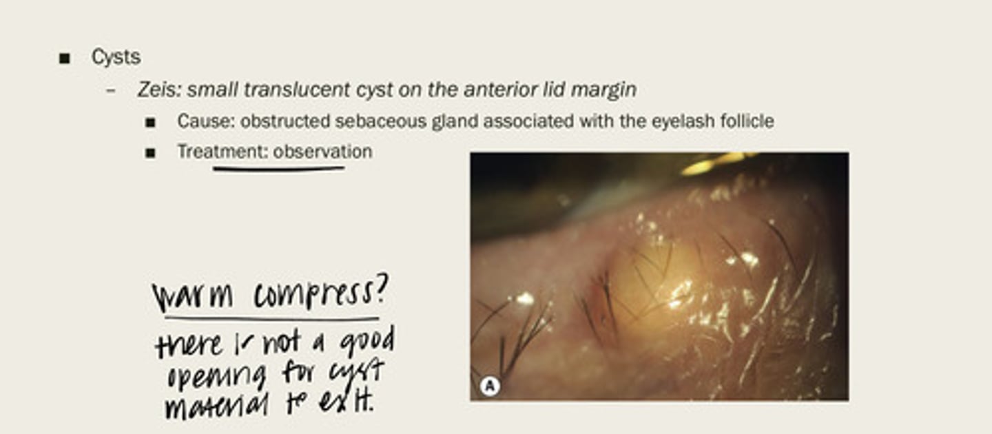 <p>What is the cause of a Zeis cyst?</p>