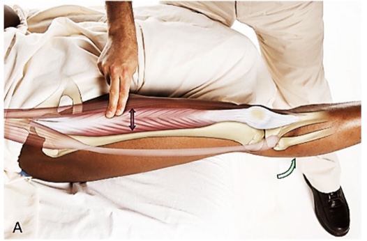 <p>rectus femoris</p>