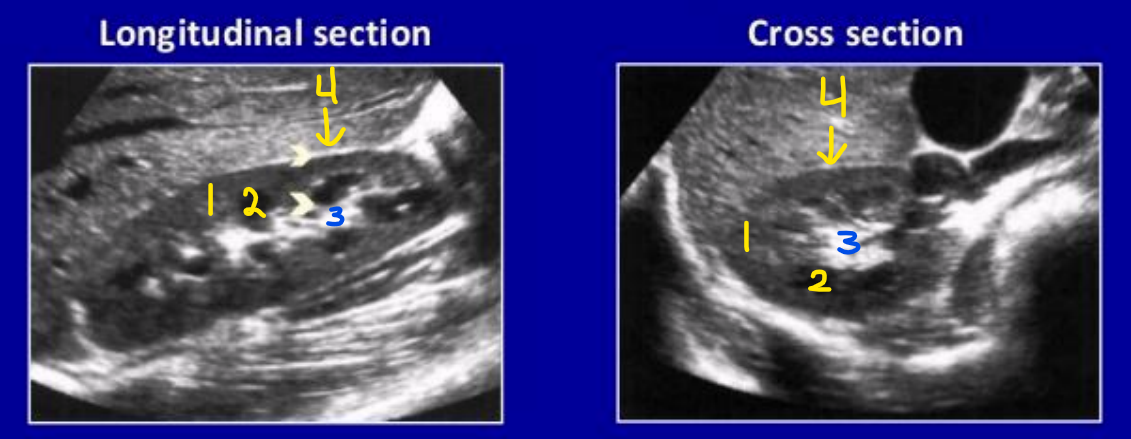 <p>What is number 3? Describe its echogenicity compared to the renal cortex</p>