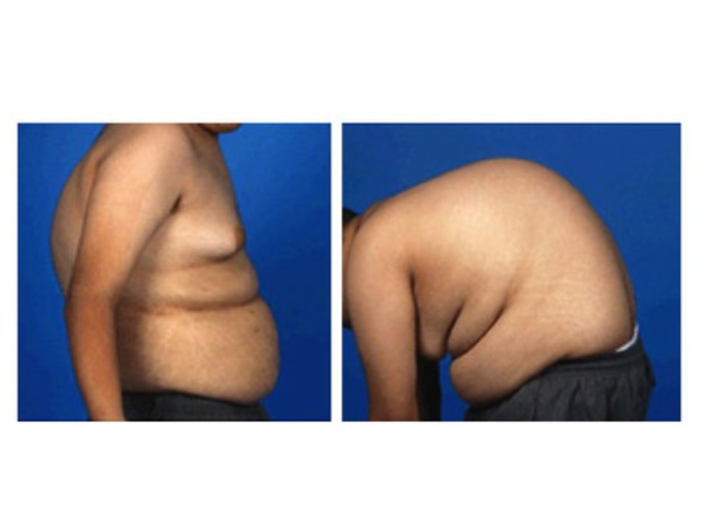 <p>excessive outward curvature of the spine causing hunching of the back</p>
