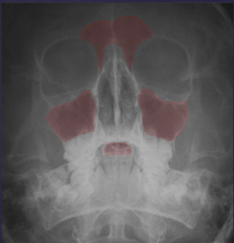 <p>evaluating maxillary sinuses </p>