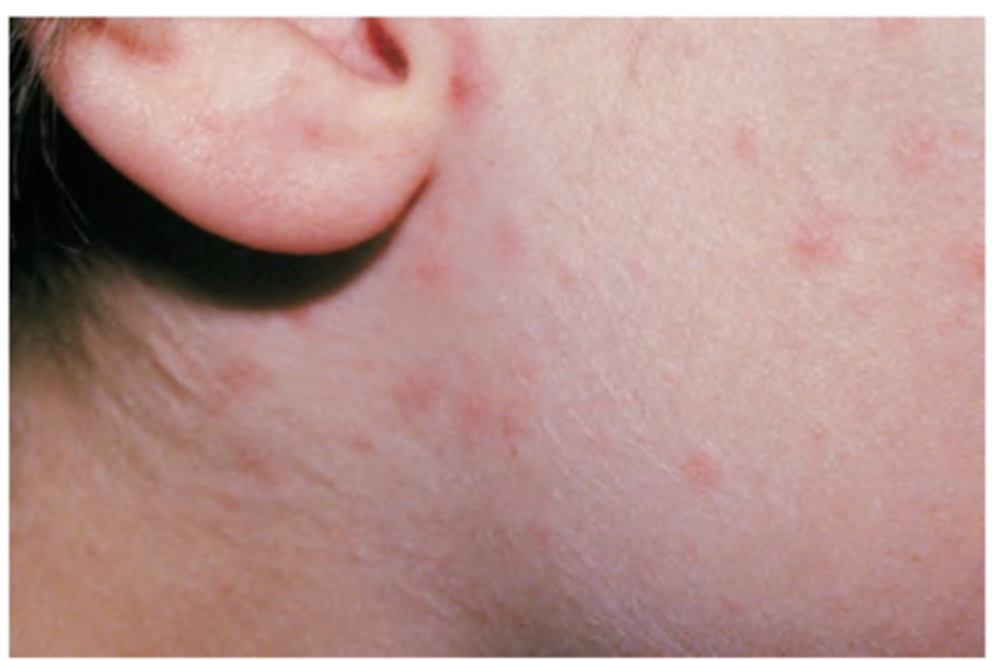 <p>Hint: maculopapular rash that blanches with pressure 1st affecting face with downward spread to trunk and extremities</p>