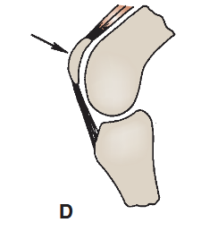 <p>small nodules of bones found on certain tendons</p><p>EX: Patella</p>