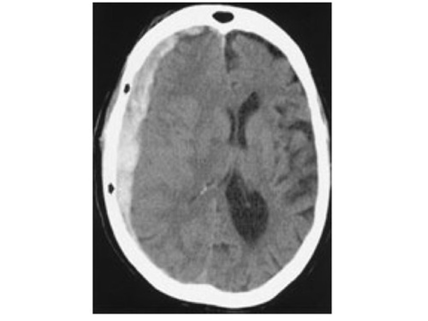 <p>Subdural hematomas appear as a concave, "crescent-shaped" density that crosses the suture lines.</p>