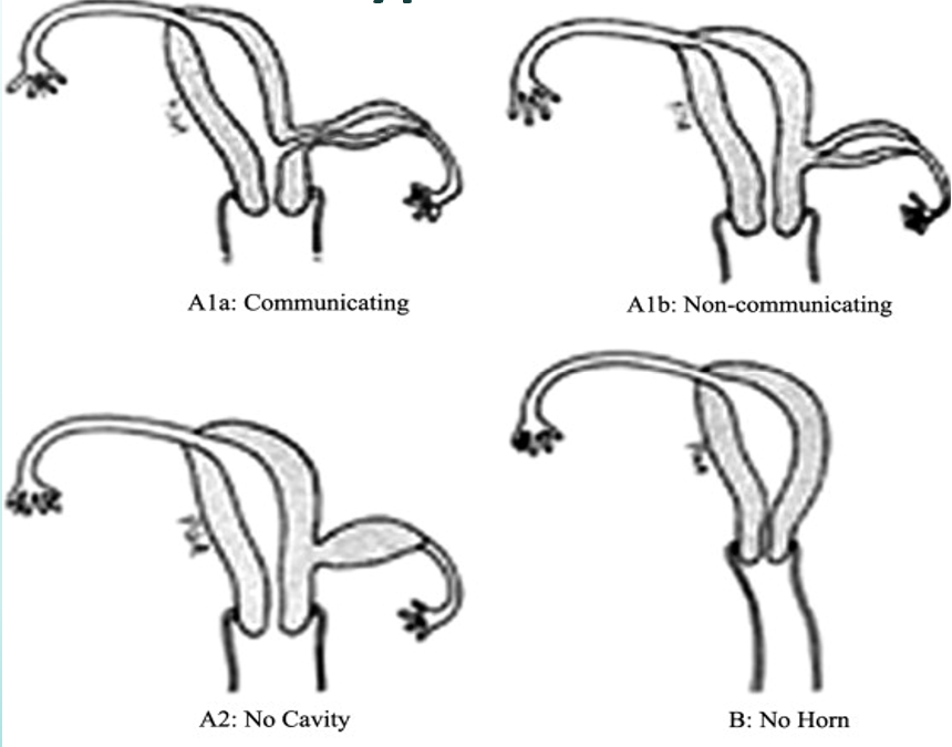 <p>developmental failure of one paramesonephric duct while the other develops normally</p>