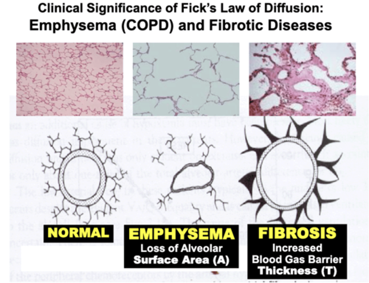 <p>Pulmonary disorders such as COPD (e.g. Emphysema) result in a significant Loss of Alveolar Surface Area compared to Normal lungs</p><p>- results from destruction of the lung’s histological elastic (elastin &amp; collagen) components (e.g. smoking)</p><p>= severely decrease gas diffusion of O2 and CO2 across the blood gas barrier</p><p>- pathophysiology is based on impairment of objective variables expressed by Fick’s Law of Diffusion</p>